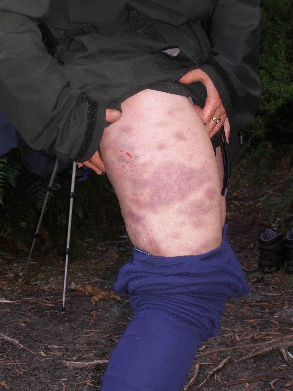 Bruised leg.jpg